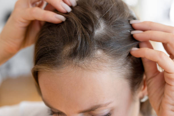 Hair transplant in Dubai
